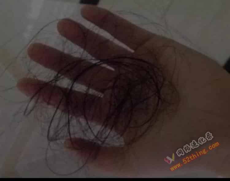 脱发怎么办（脱发是什么原因引起的）