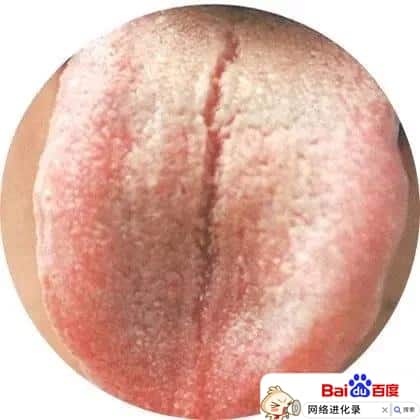 舌头裂口子是什么原因怎么治疗，网友这么说