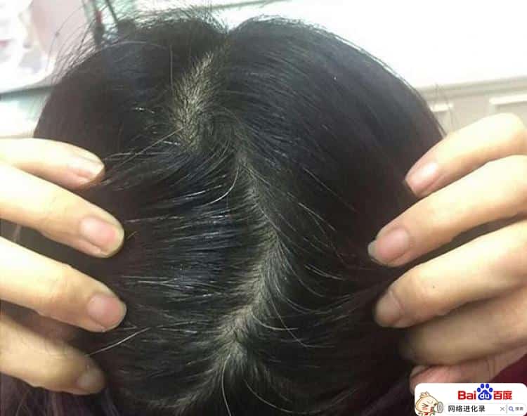 白头发怎么治才能黑（治白头发最有效的方法）