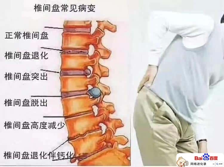 腰椎间盘突出怎么锻炼（腰间盘突出应该注意哪些）