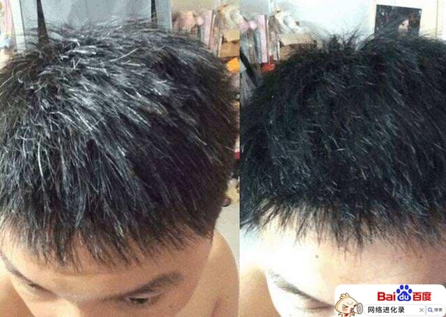 白头发怎么治才能黑（治白头发最有效的方法）